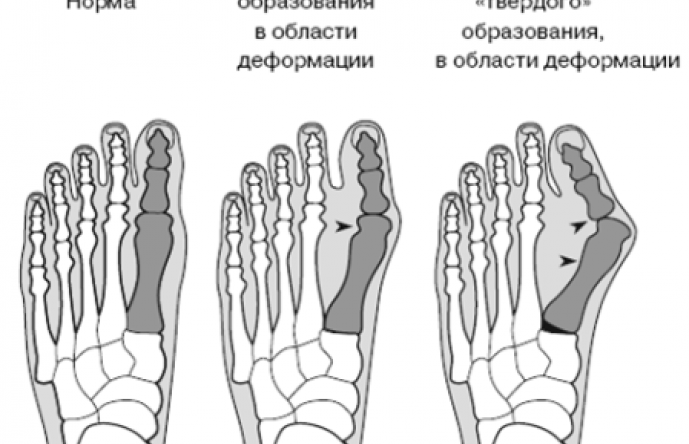 Эффективное лечение косточки на ноге