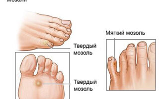 Почему болит свод стопы при ходьбе и как лечить проблему?
