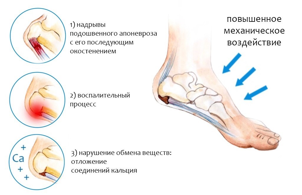 Пяточная шпора