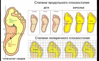 Как можно определить: какое плоскостопие — поперечное или продольное?