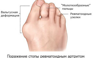 Чем можно лечить артрит стопы?