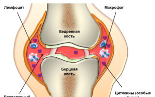Болит пятка внутри стопы: почему это происходит?