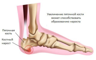 Применяемое физиолечение при пяточной шпоре