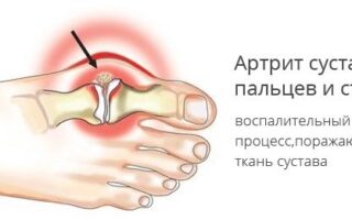 Причины и лечение артрита большого пальца стопы