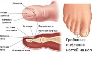 лечение грибка стопы дома уксусом
