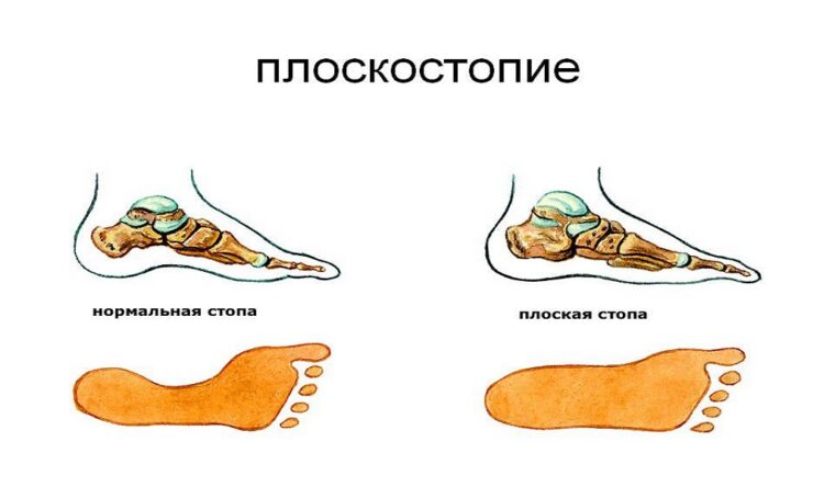 Какую обувь следует носить при плоскостопии?