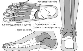 Как проводят лечение артрита стопы ног в домашних условиях