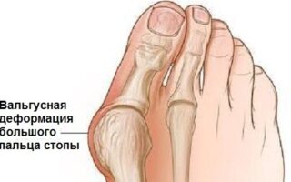 Какие упражнения для стоп выполняются при вальгусной деформации?
