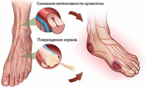 Какие препараты используются для лечения диабетической стопы?