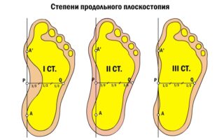 Какой врач может лечить пяточную шпору?