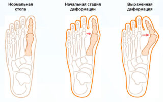Как нужно делать массаж при вальгусной установке стоп?