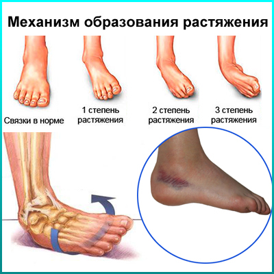 Степени повреждения связок стопы