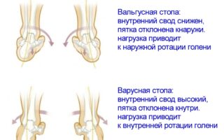 Какие нужны упражнения при варусной постановке стоп?