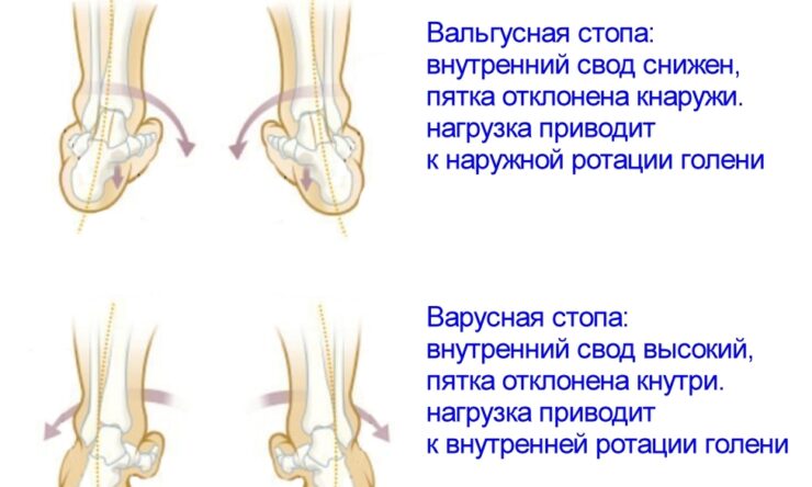 Какие нужны упражнения при варусной постановке стоп?