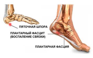 Симптомы и лечение периартрита стопы