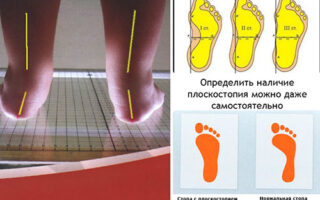 Причины плоскостопия у детей и лечение в домашних условиях
