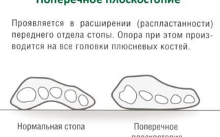 Причины и лечение народными средствами поперечного плоскостопия