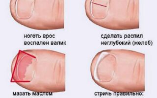 Если беспокоит вросший ноготь на большом пальце ноги лечение