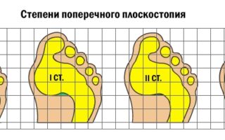 Главные симптомы и лечение поперечного плоскостопия у детей